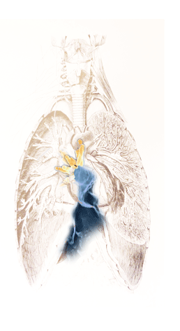 Imagen: Mycobacterium tuberculosis en los pulmones