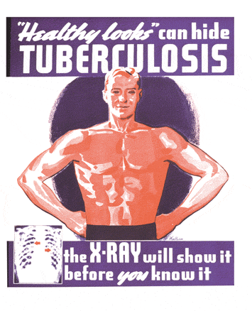 Ilustración: Tuberculosis